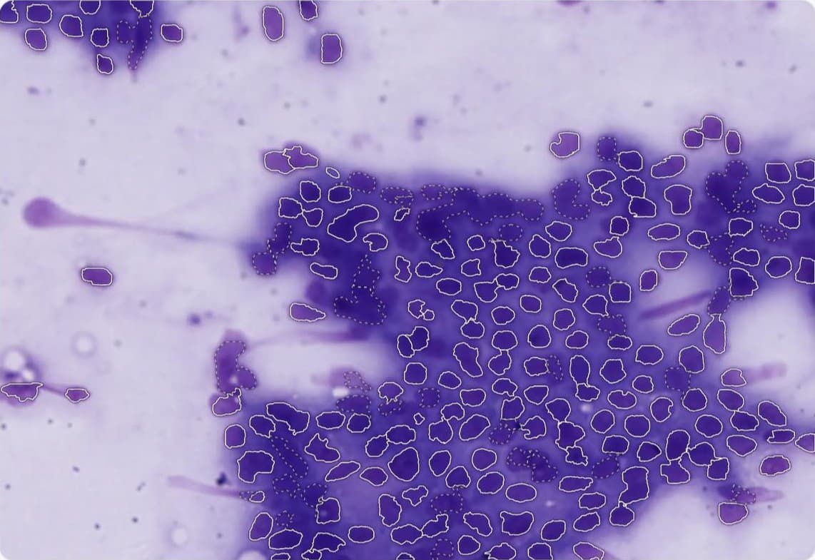 OncoScan measuring a real breast cytology slide: the server has outlined about two hundred cell nuclei in white.